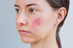 Close-up young Caucasian woman suffering from rosacea on her face in the acute stage. Skin chronic disease. Dermatological problems.