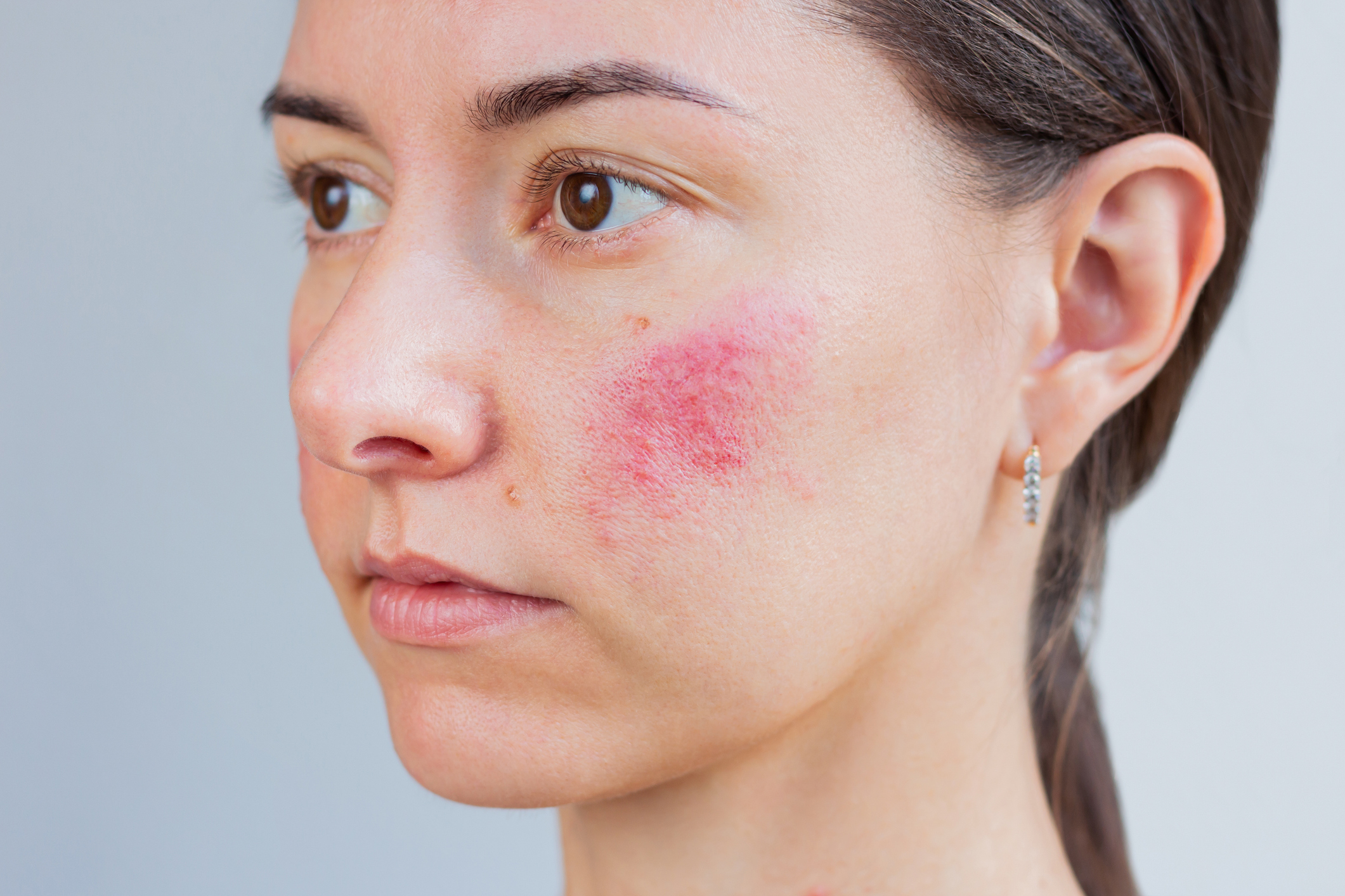Close-up young Caucasian woman suffering from rosacea on her face in the acute stage. Skin chronic disease. Dermatological problems.