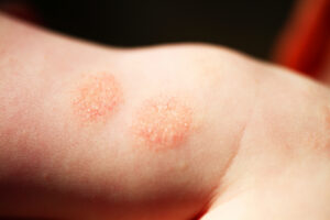 dermatitis child