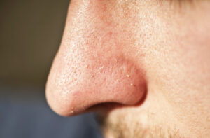 Close-up of human facial pores and squeezed out whiteheads