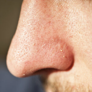 Close-up of human facial pores and squeezed out whiteheads