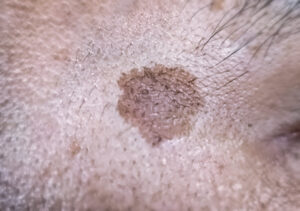 Close up of a lesion of actinic keratosis or sunspots on sun-damaged skin of the eye side of the forehead of a man. This can be treated with cryosurgery or certain ointments.